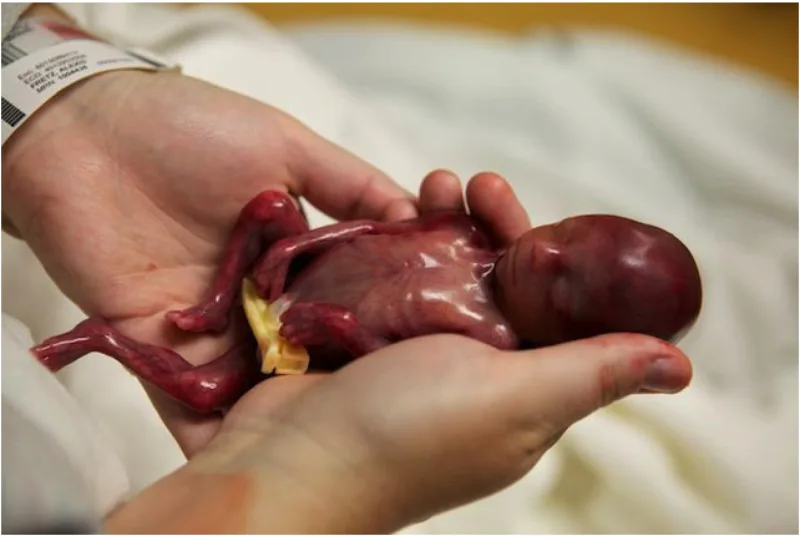 El bebé que está cambiando el debate sobre el aborto en el mundo