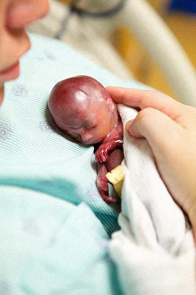 Madre e hijo aborto - El bebé que está cambiando el debate sobre el aborto en el mundo